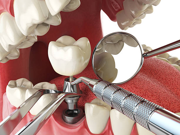 Best Emergency Root Canal Treatment in Brownsville, FL